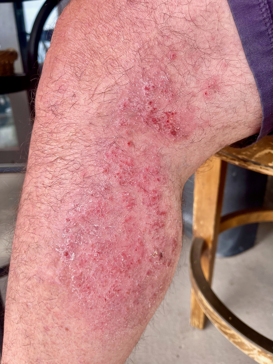 屁股坐地上长疹子？原因、症状和治疗