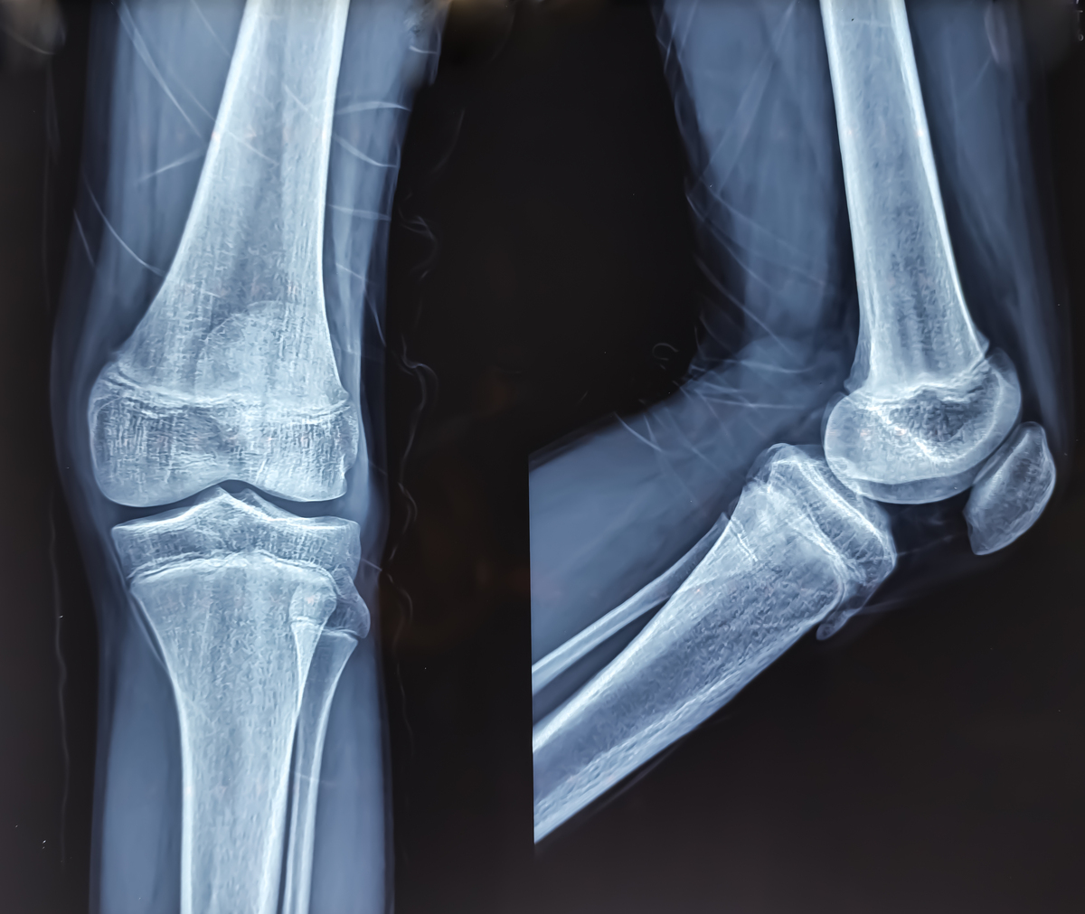退行性关节炎应该挂哪一科在骨科中属于哪一小类