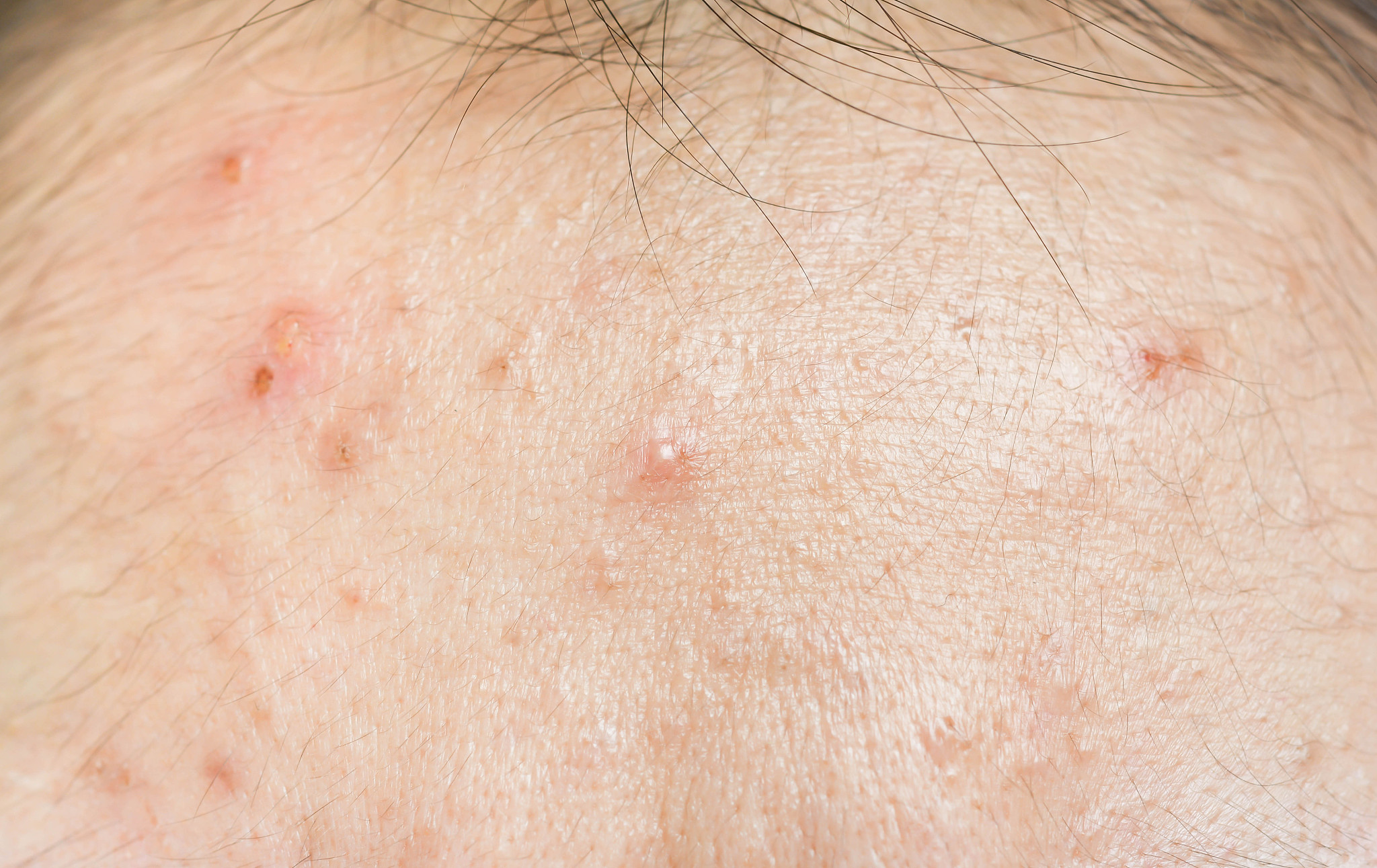 scar from acne on face