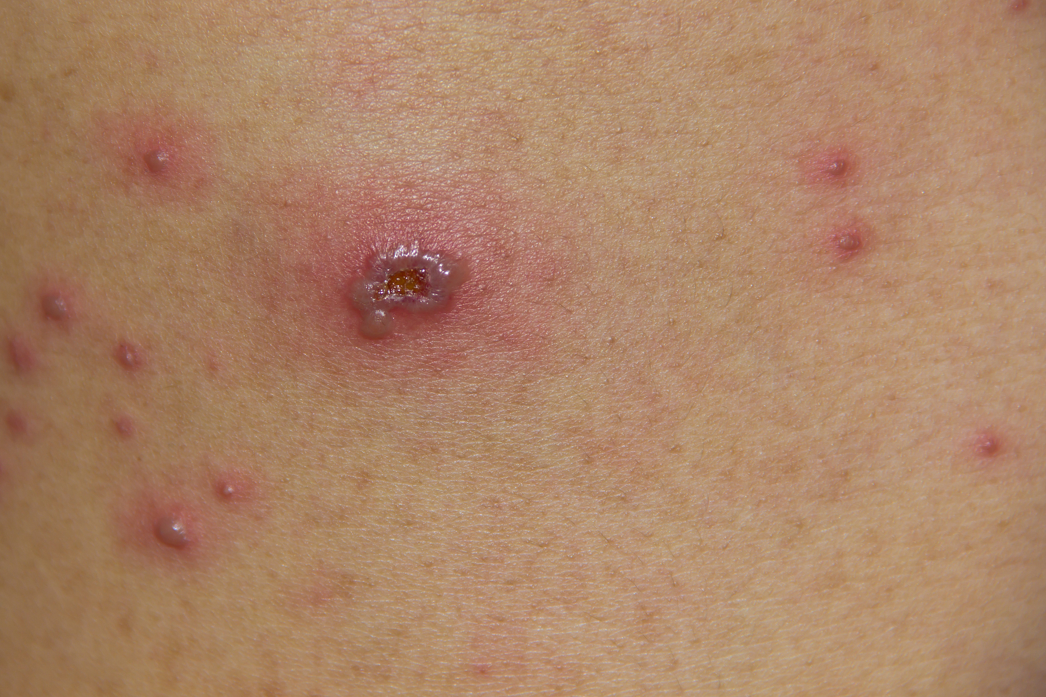 chickenpox