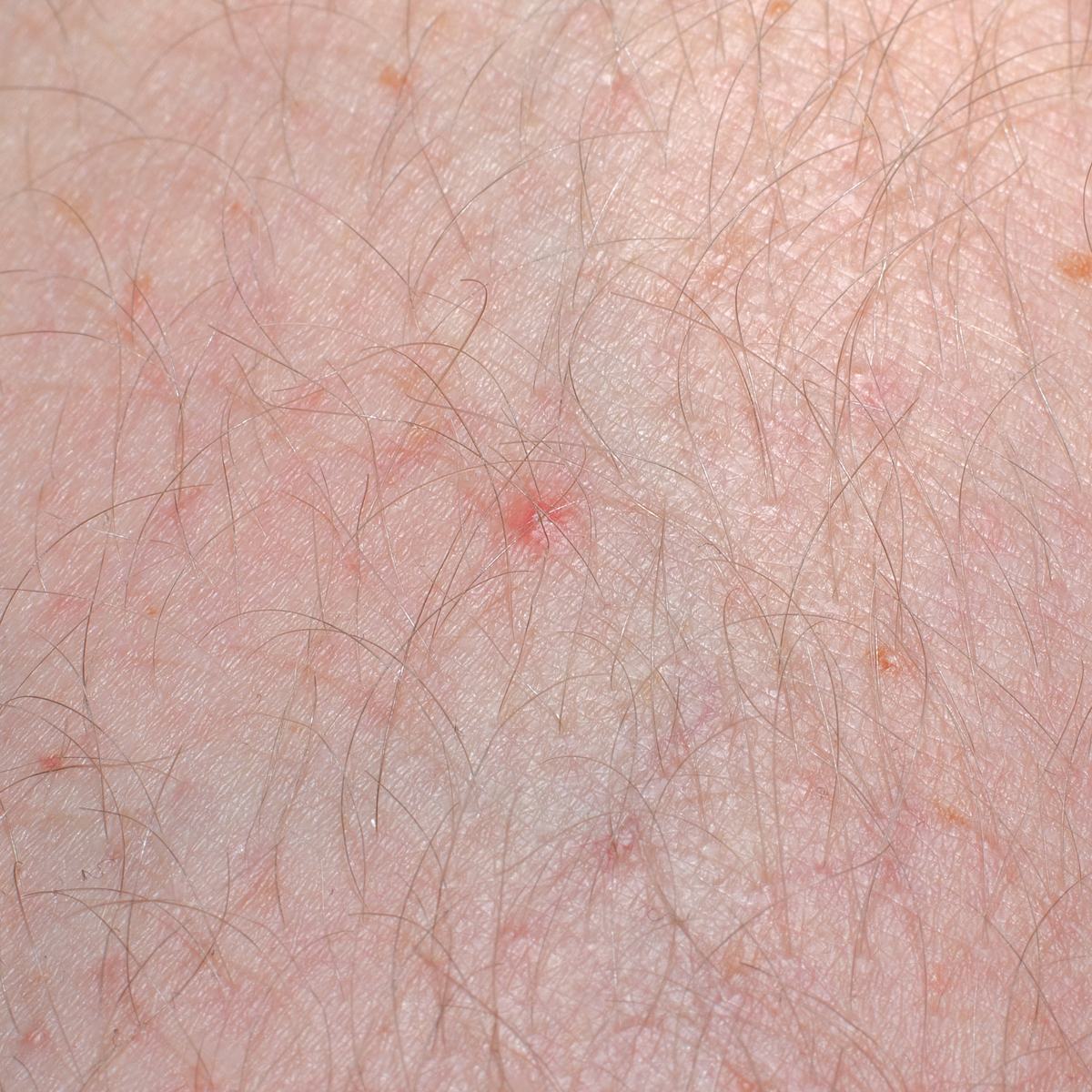 毛囊炎是什么？症状、原因及治疗方法