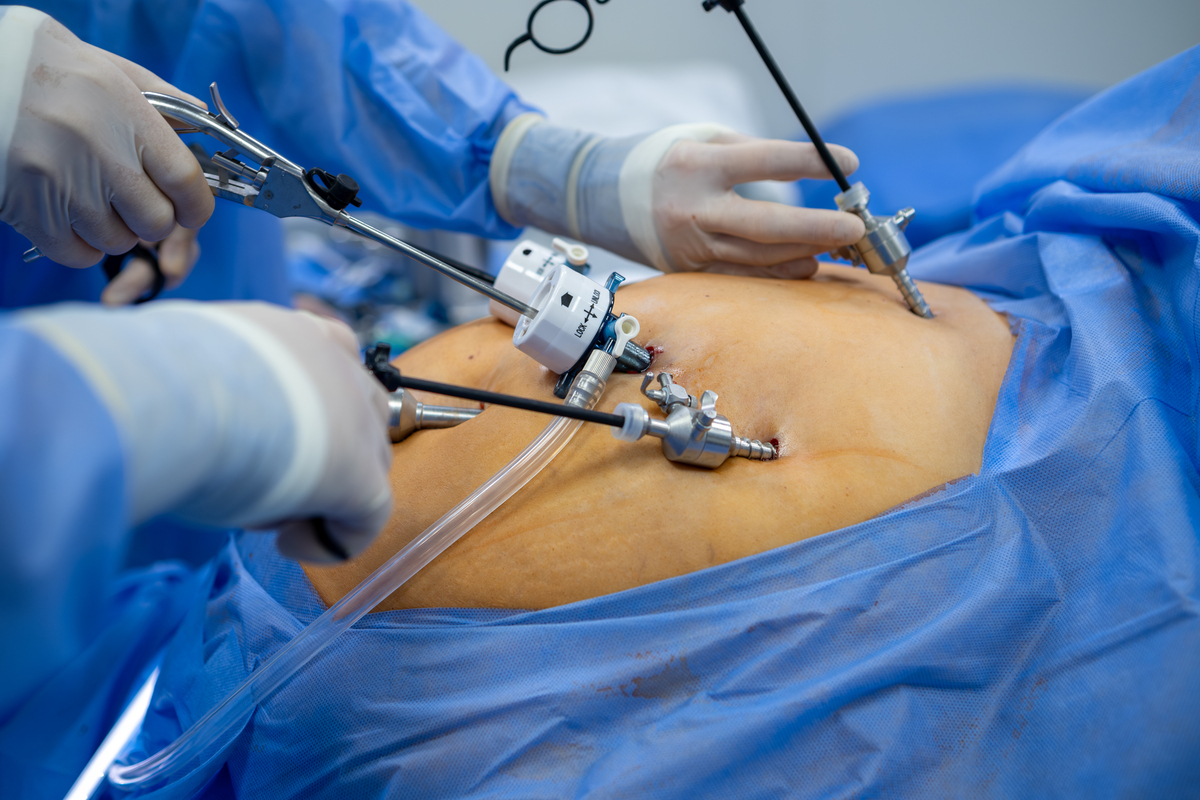 腔镜下子宫全切术的优势