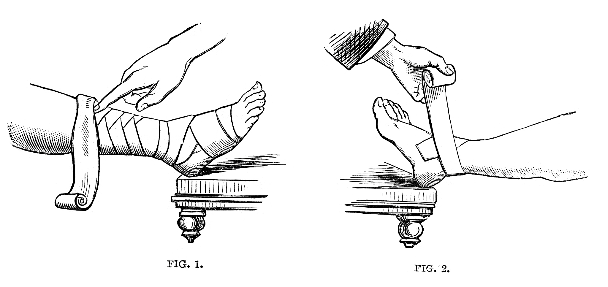 Broström法修复距腓前韧带损伤：带线锚钉的应用及临床效果