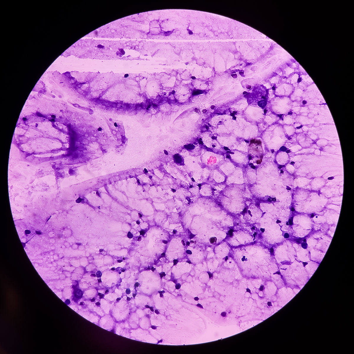 良性乳腺肿块和恶性乳腺肿块的区别：形状、大小、位置