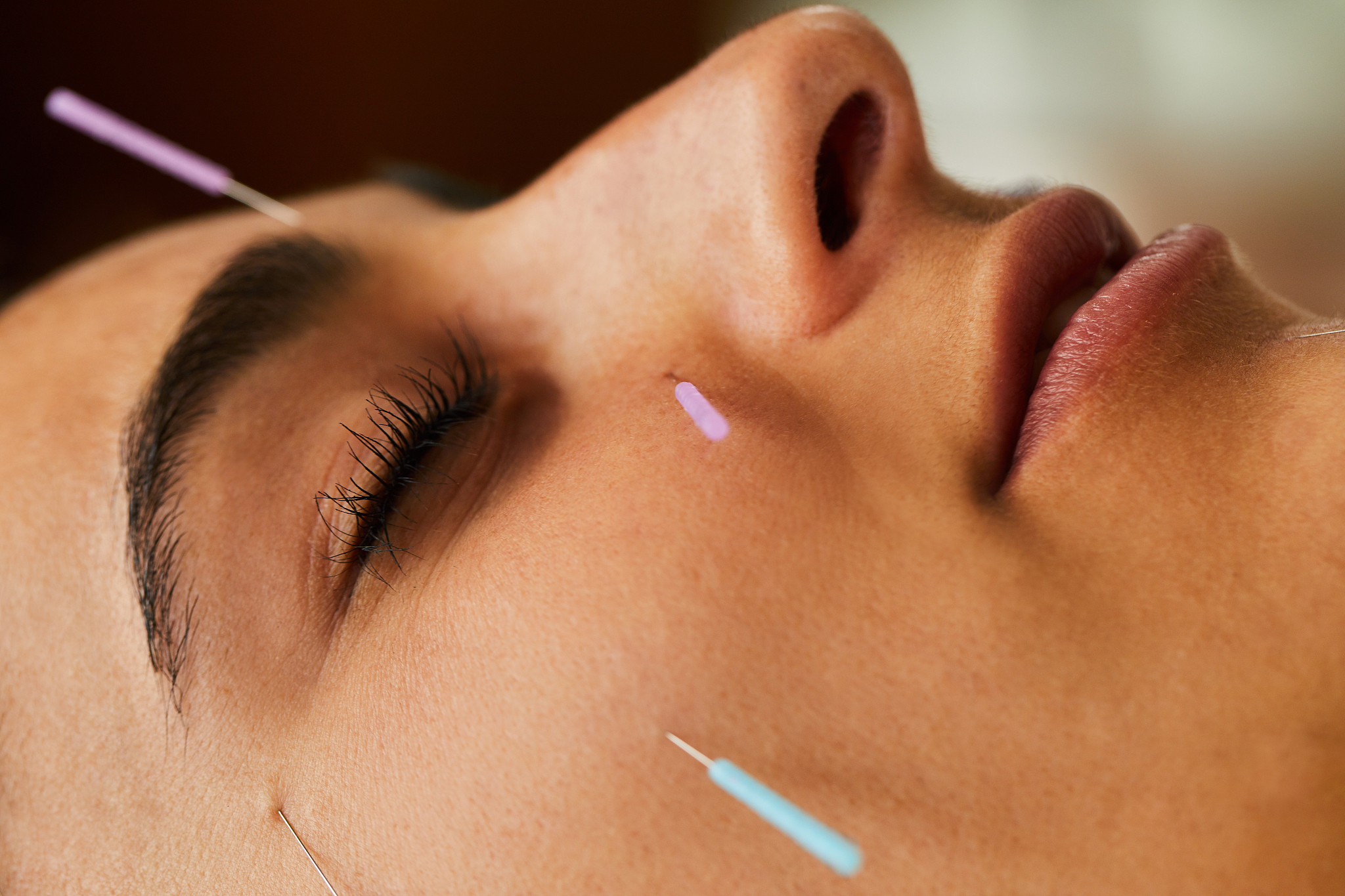 young woman getting an acupuncture session done on her face