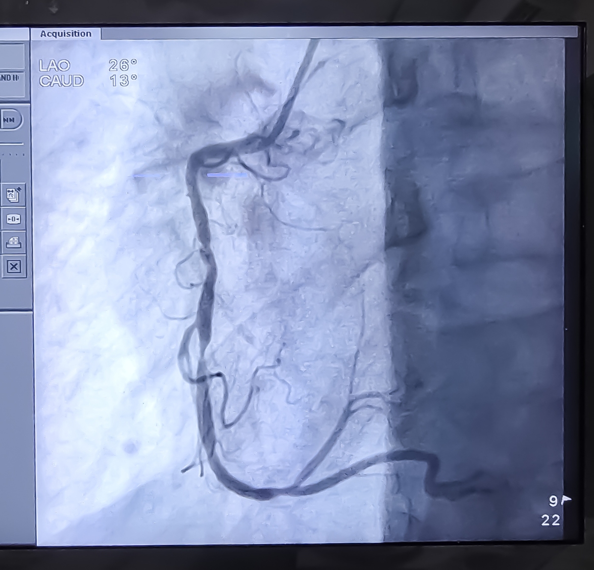颈动脉斑块破裂形成的溃疡和漂浮血栓：超声造影和CTA/DSA证实