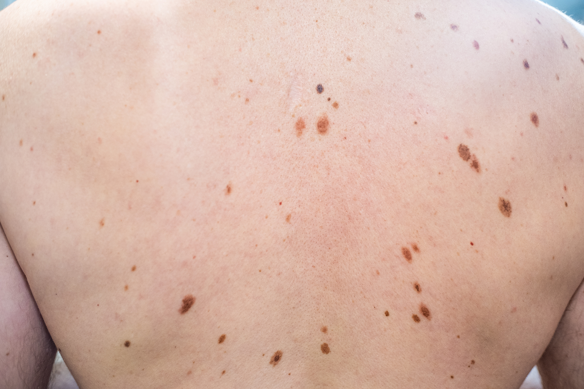 melanocytic nevus, some of them dyplastic or atypical, on a cauc