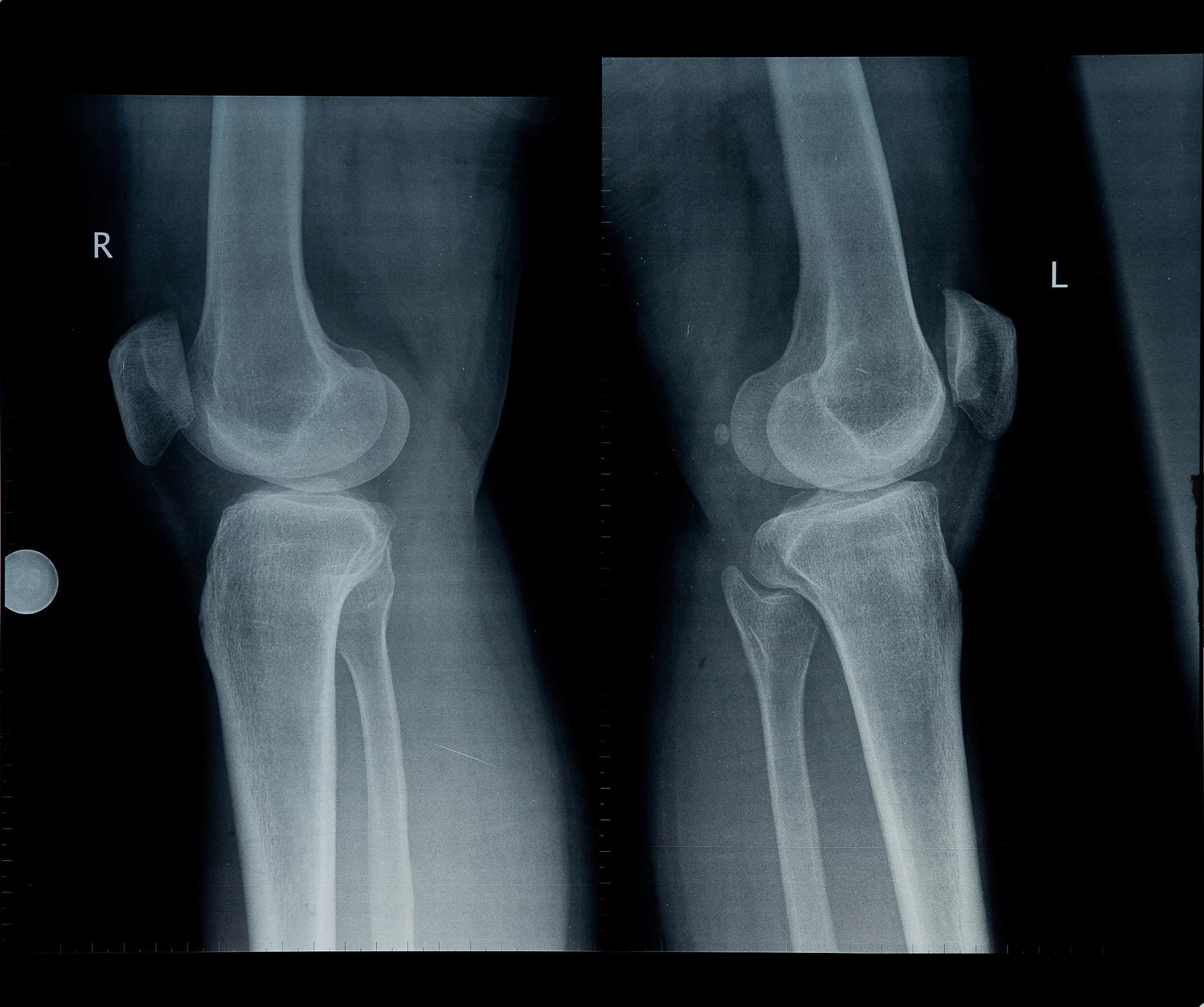 骨骺线闭合时间：男女差异、影响因素及评估方法