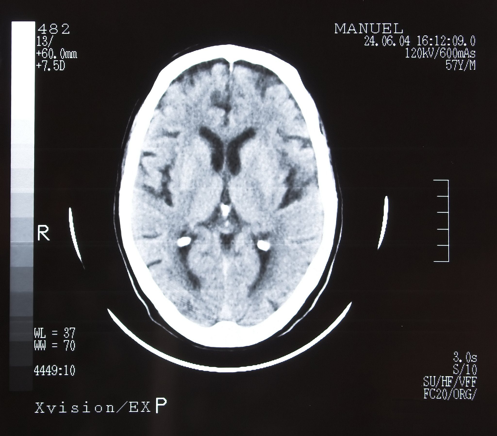 针对医学图像配准任务1分别列举两种所涉及的具体技术并进行阐述；2以及简要讨论所列举技术的适用应用场景或者临床适应症给出合理的理由。