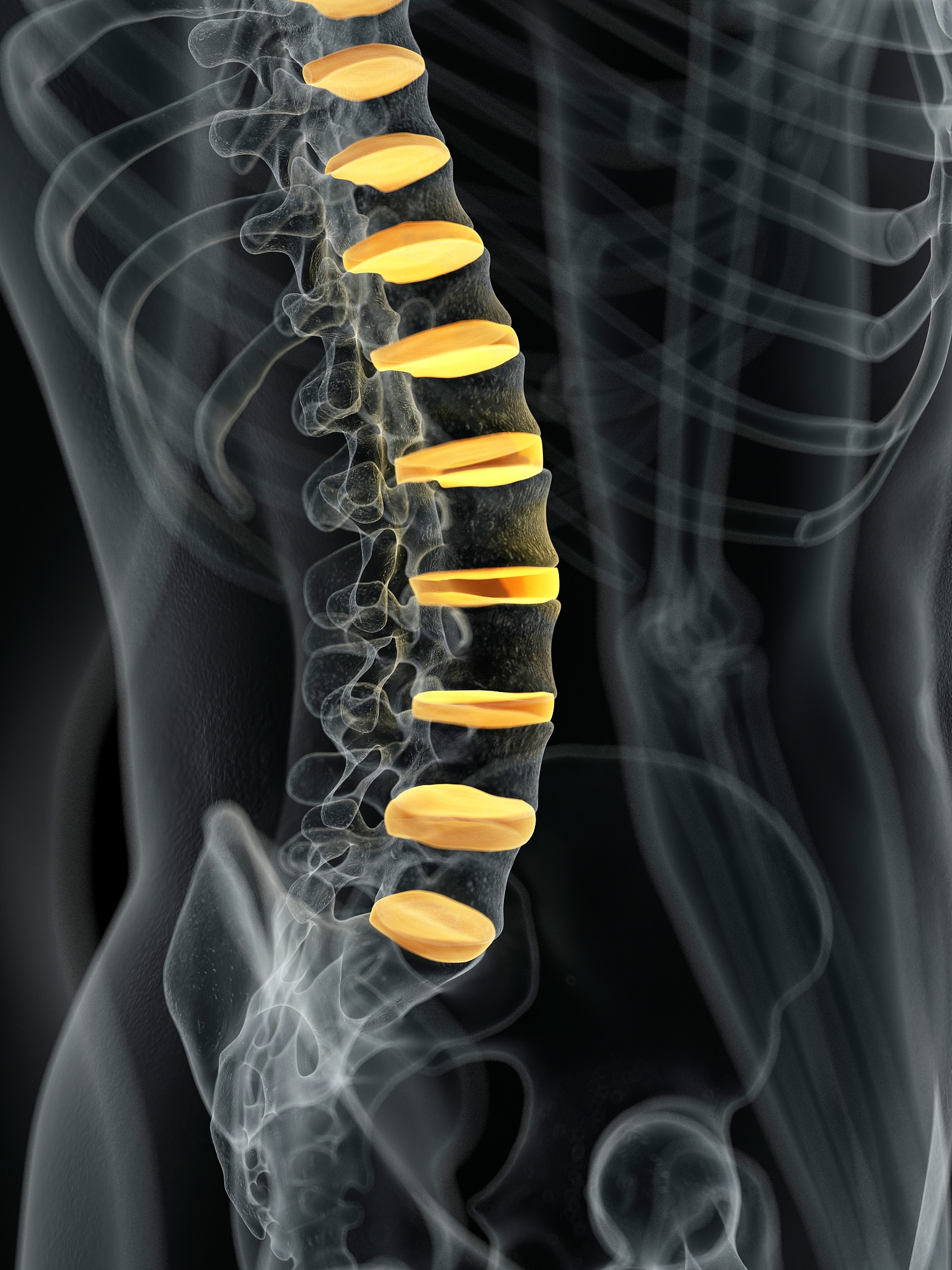腰椎间盘突出病症的流行病学