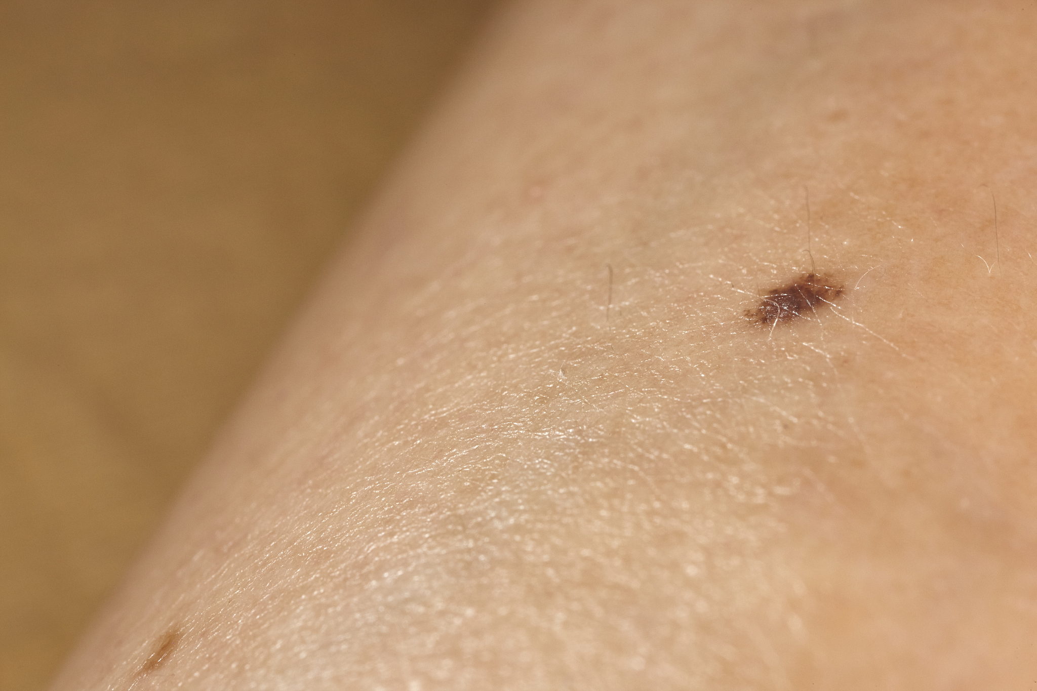 skin melanoma macro