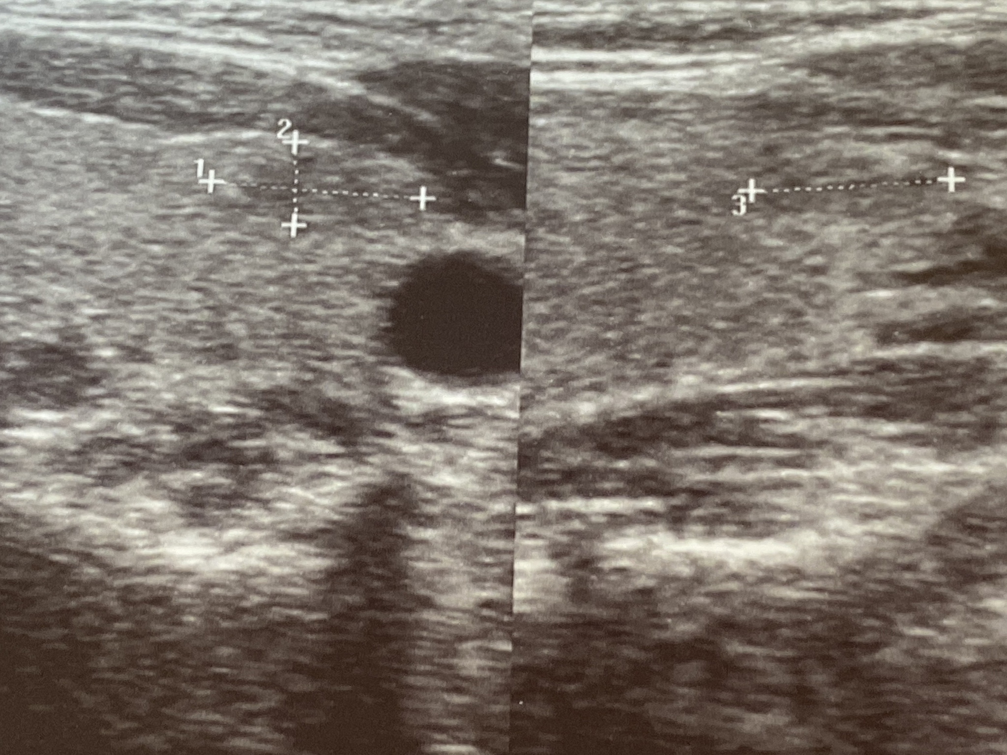 甲状腺肿瘤检查：甲状腺外科医生如何诊断？