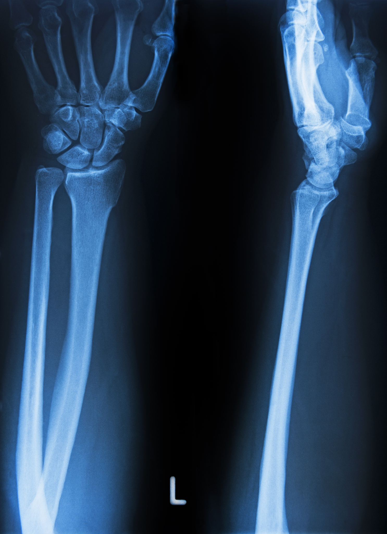 中级MCP关节： 手指和脚趾弯曲的关键