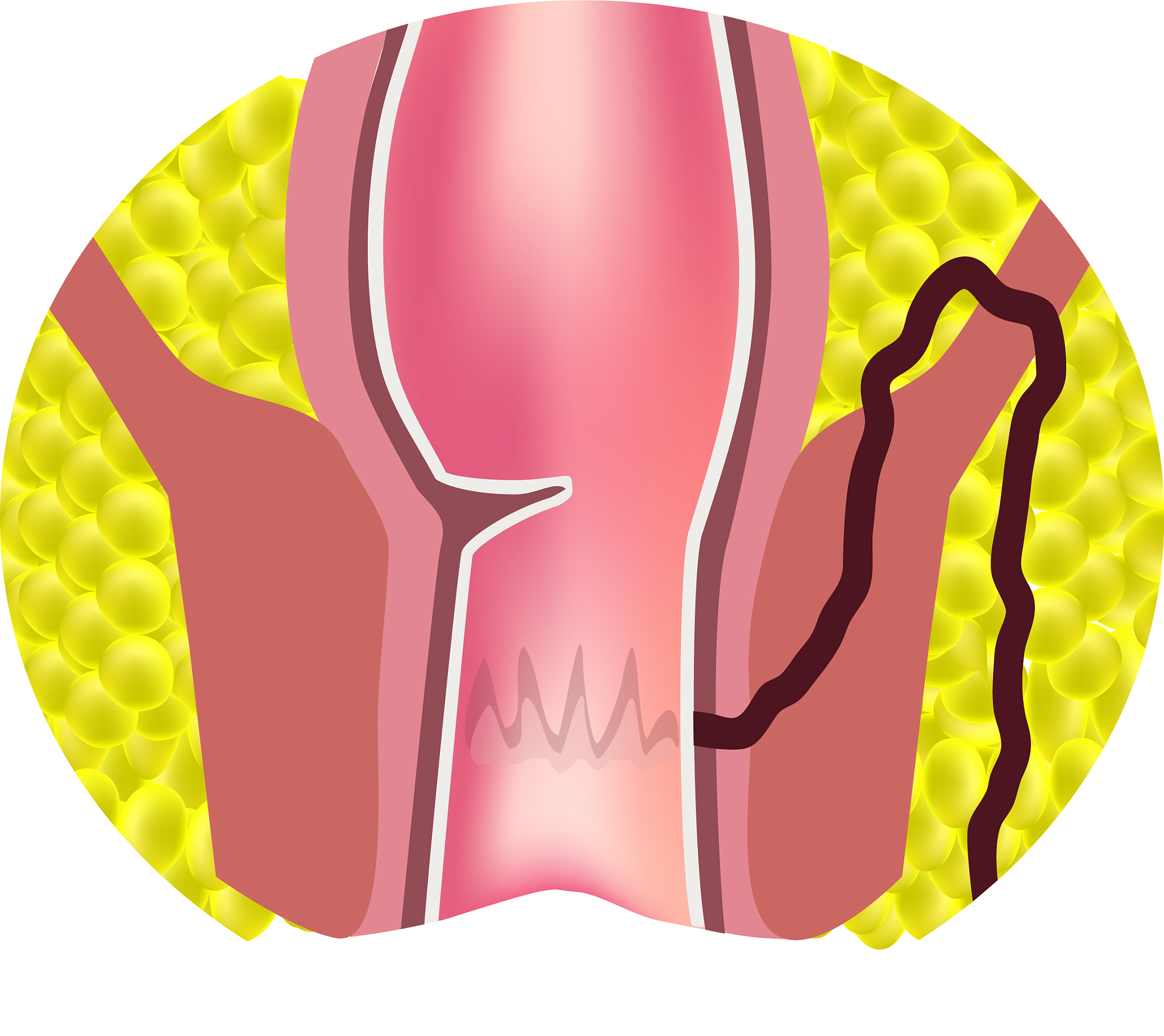 痔疮患者的独特优势：从幽默角度看