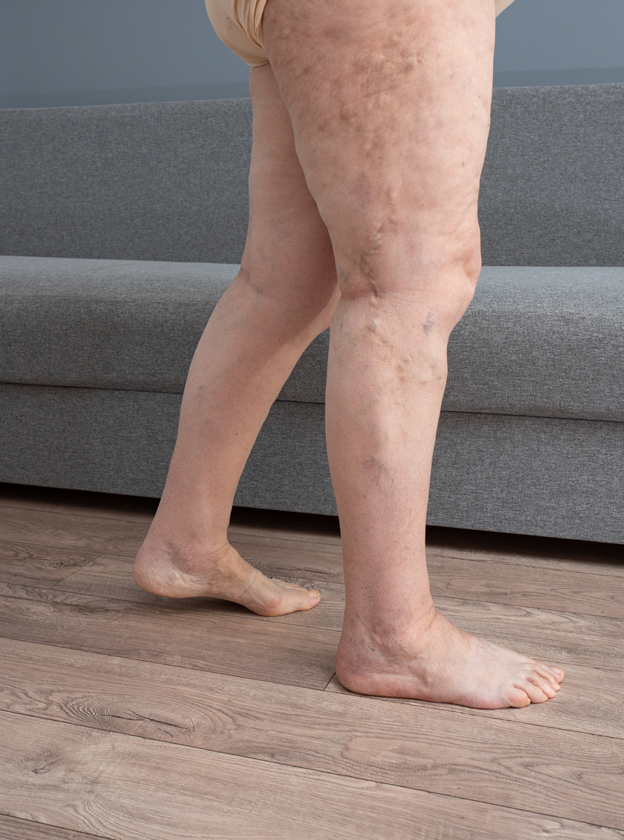 静脉曲张早期症状：腿肿胀酸胀？可能是静脉曲张！