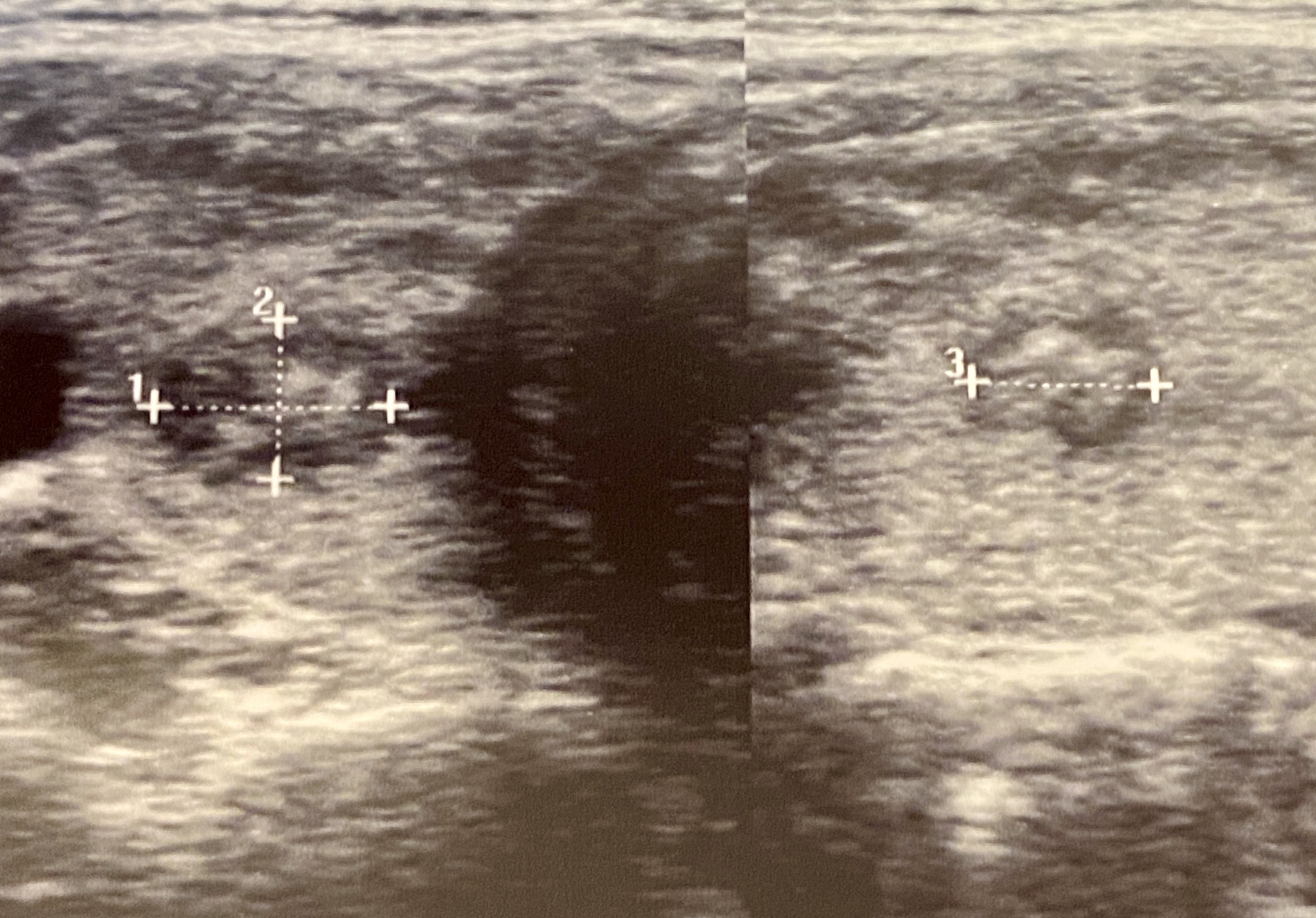 甲状腺肿瘤检查：甲状腺外科医生如何诊断？