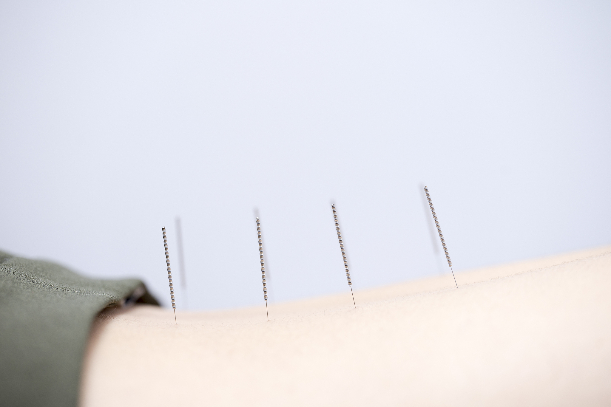 acupuncture back pain healing