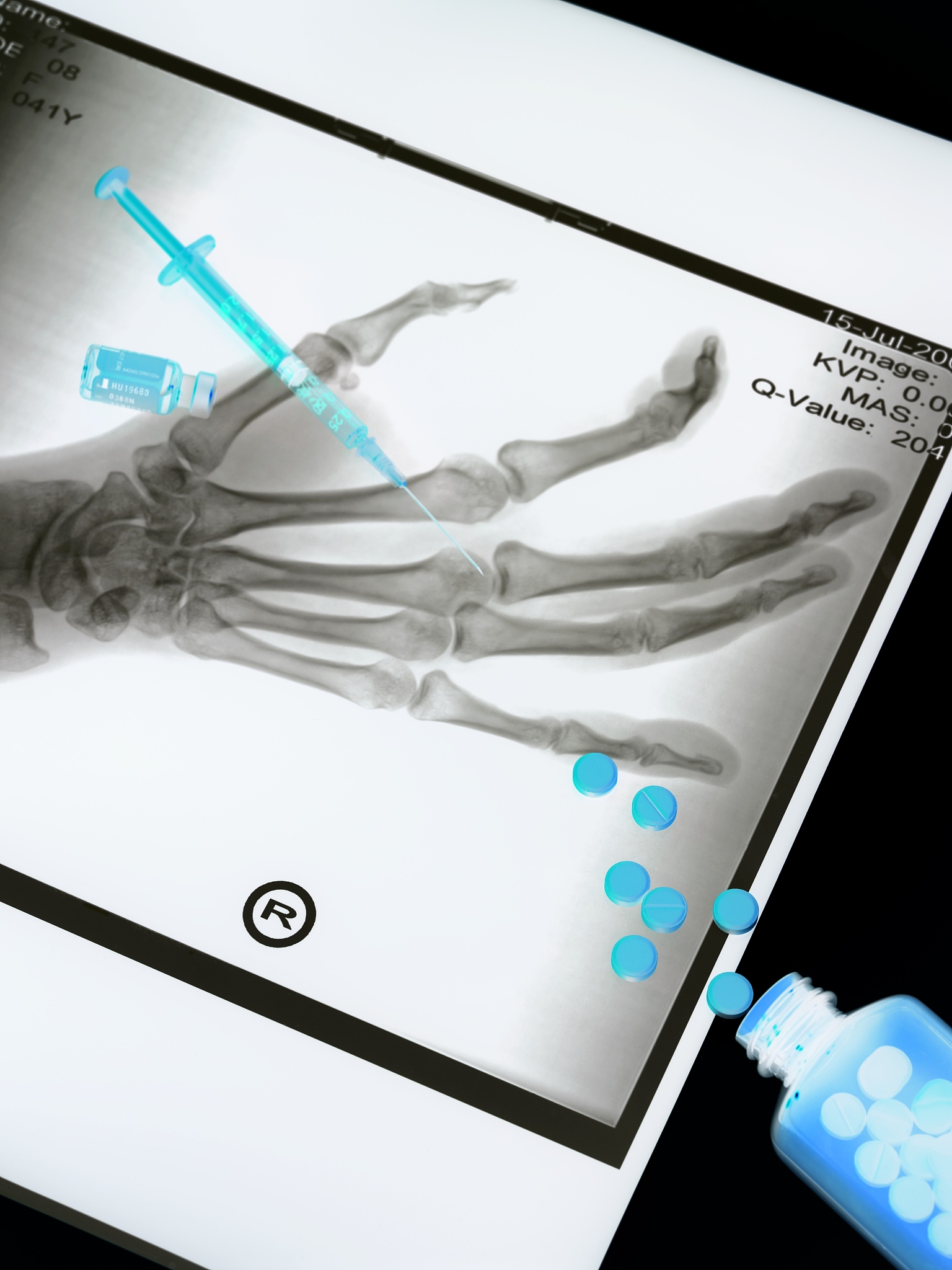 全关节镜下修复距腓前韧带治疗慢性踝关节不稳: 一项有效且相对安全的方法