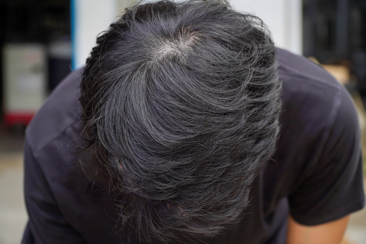 男士M型脱发怎么办？有效治疗方法汇总