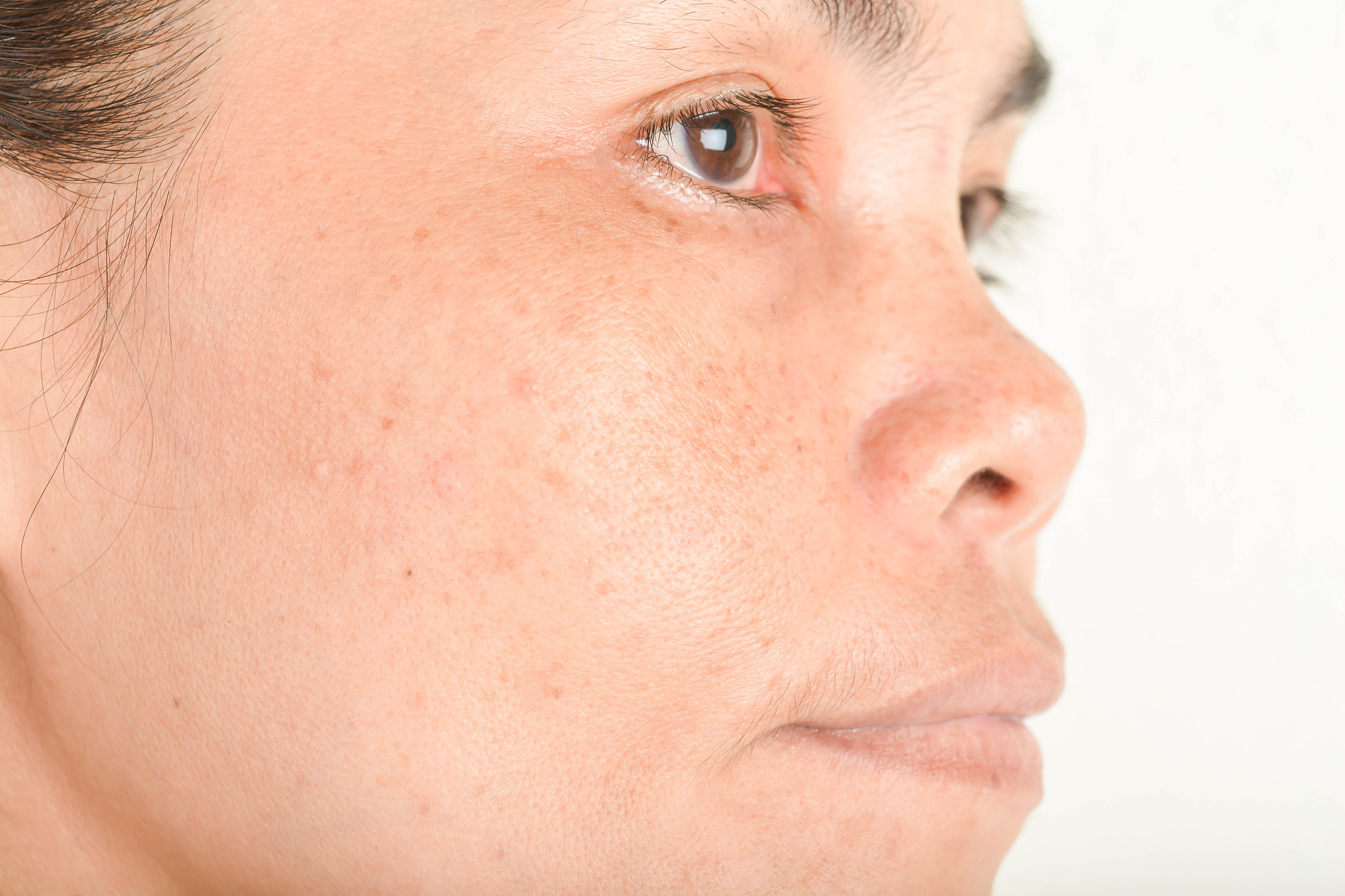 freckles on the face