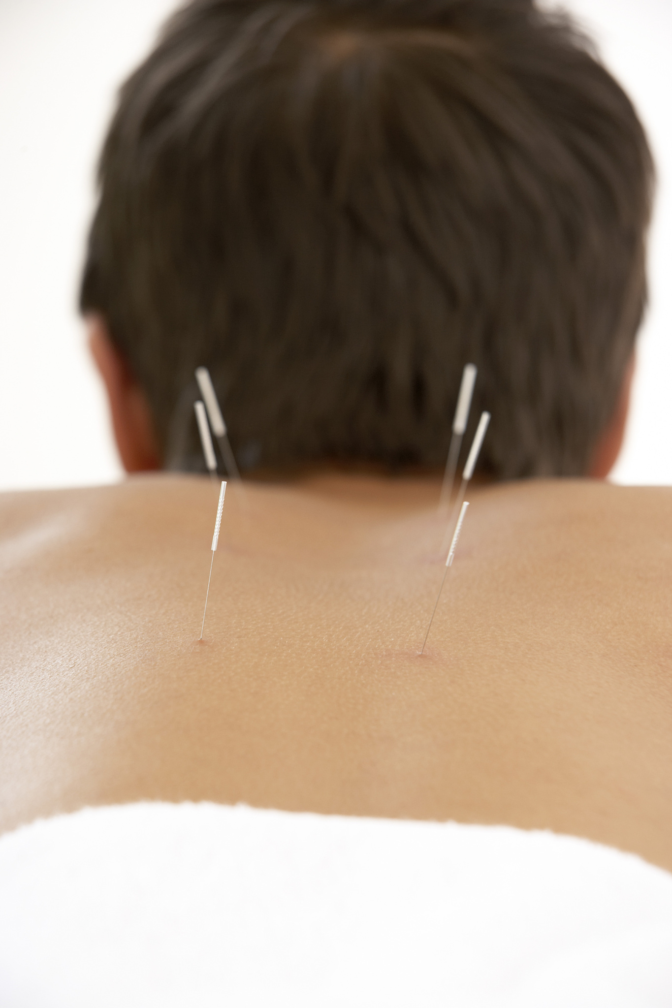 man receiving acupuncture