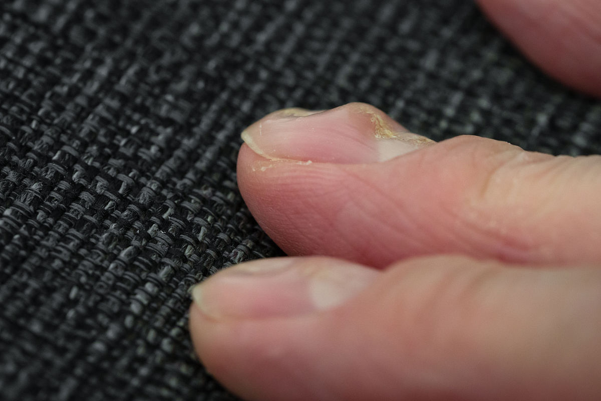 指甲月牙变少的原因：年龄、伤害、疾病、营养？