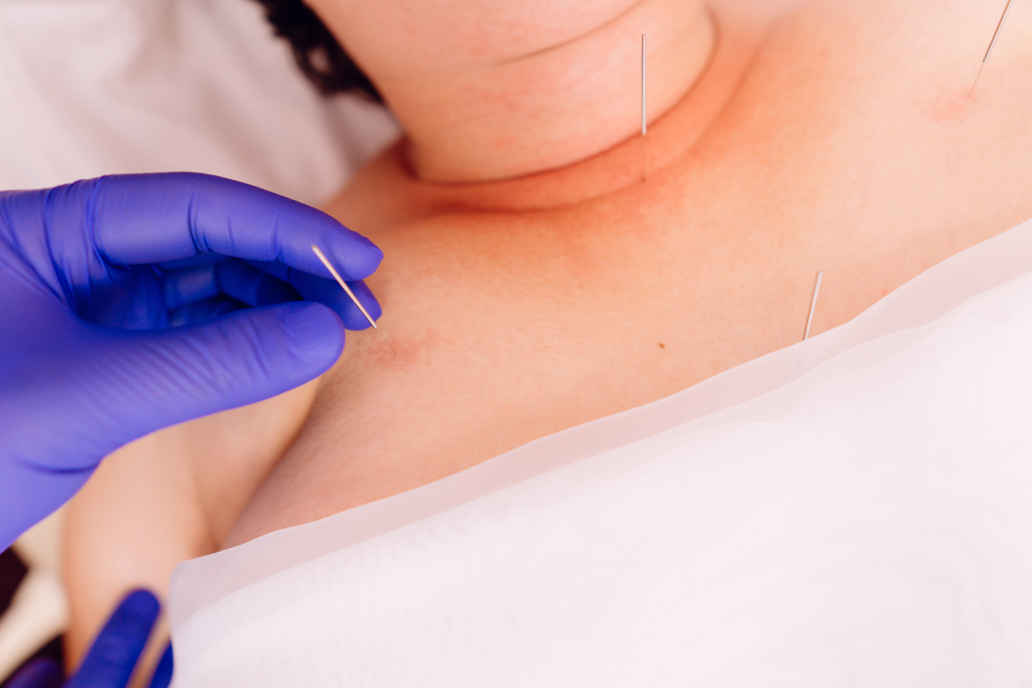 young woman getting acupuncture treatment
