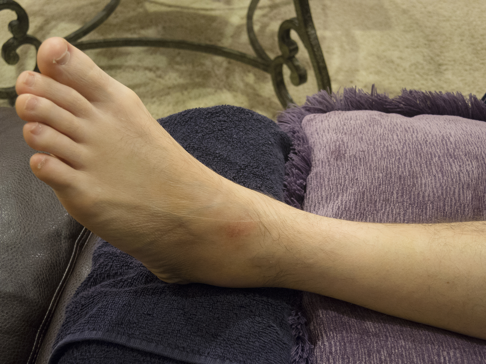 脚扭了为什么会肿