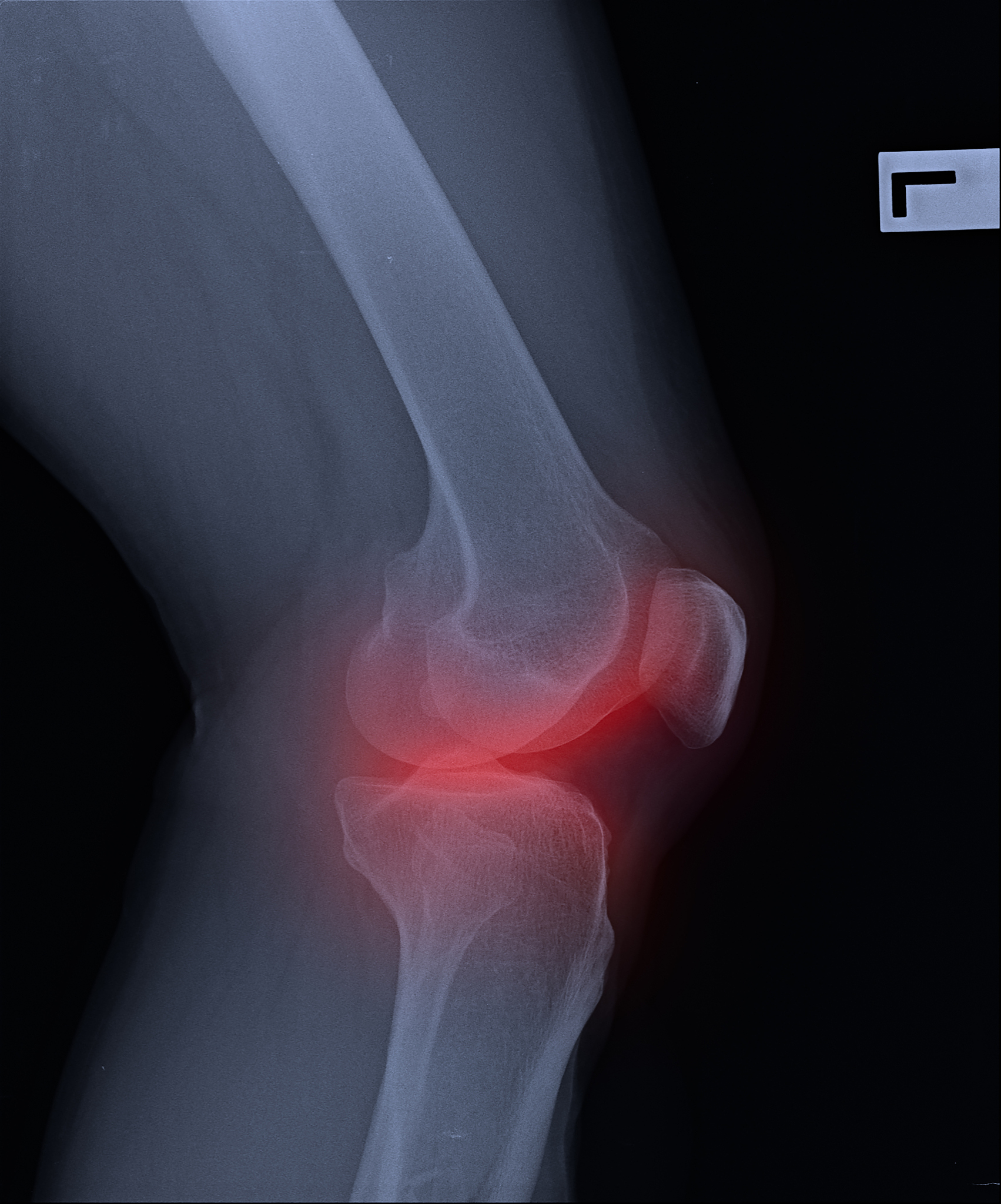 膝关节骨性关节炎：症状、原因、治疗和预防