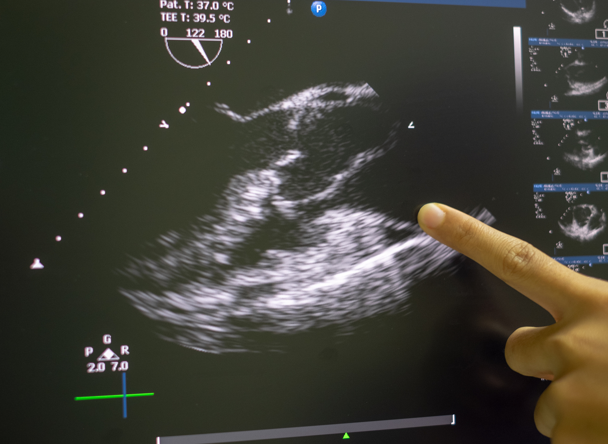 血管内超声诊断导管的市场现状国外和国内的市场占比等信息