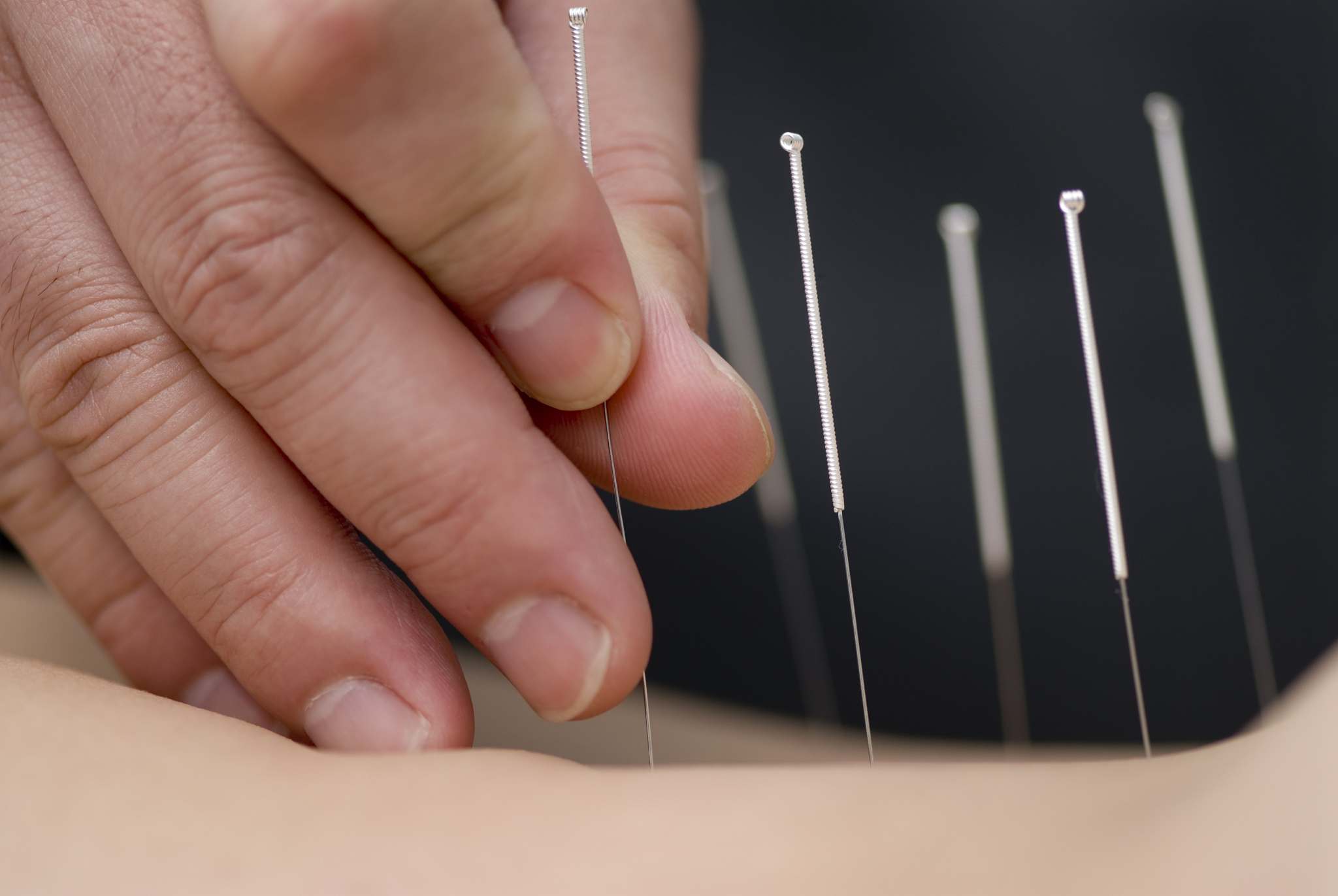 treatment by acupuncture