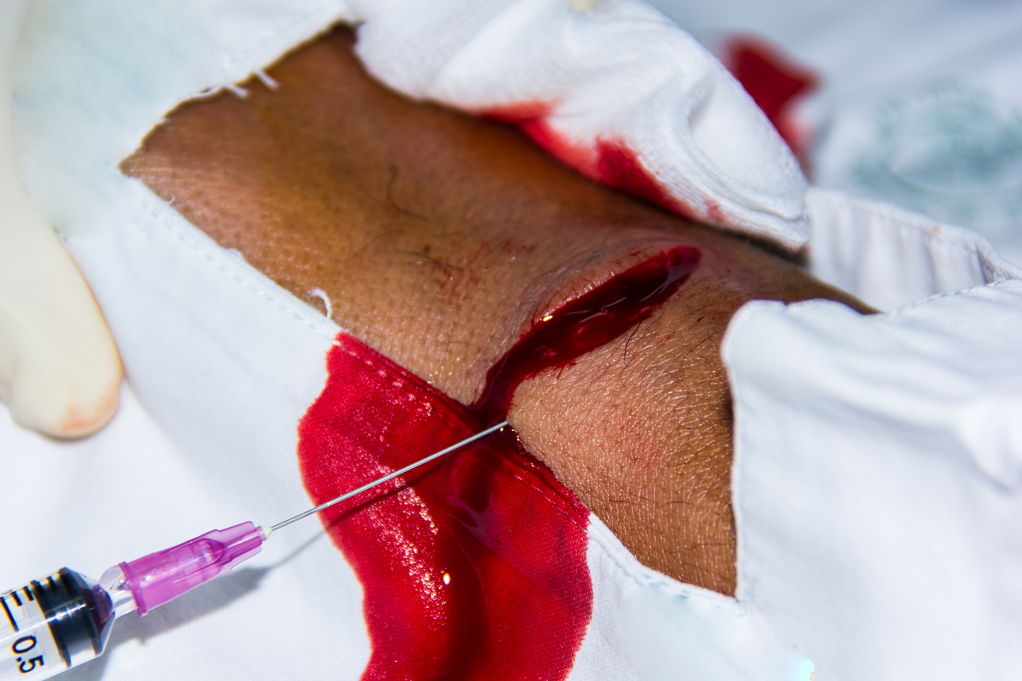 脂肪瘤怎么办？如何处理和治疗？