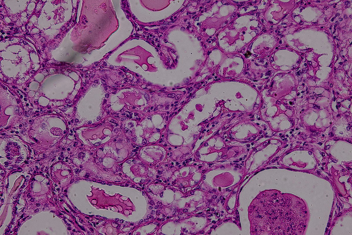 乳腺肿瘤分割：准确识别肿瘤区域，助力精准治疗