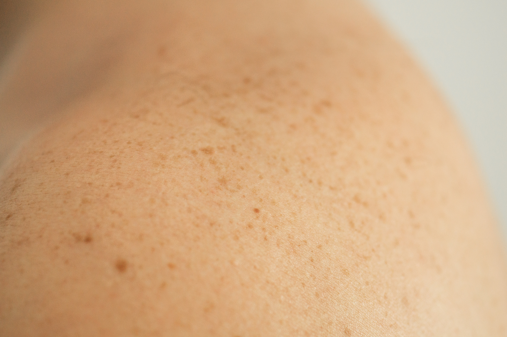 close up detail of the bare skin on a man back with scattered mo