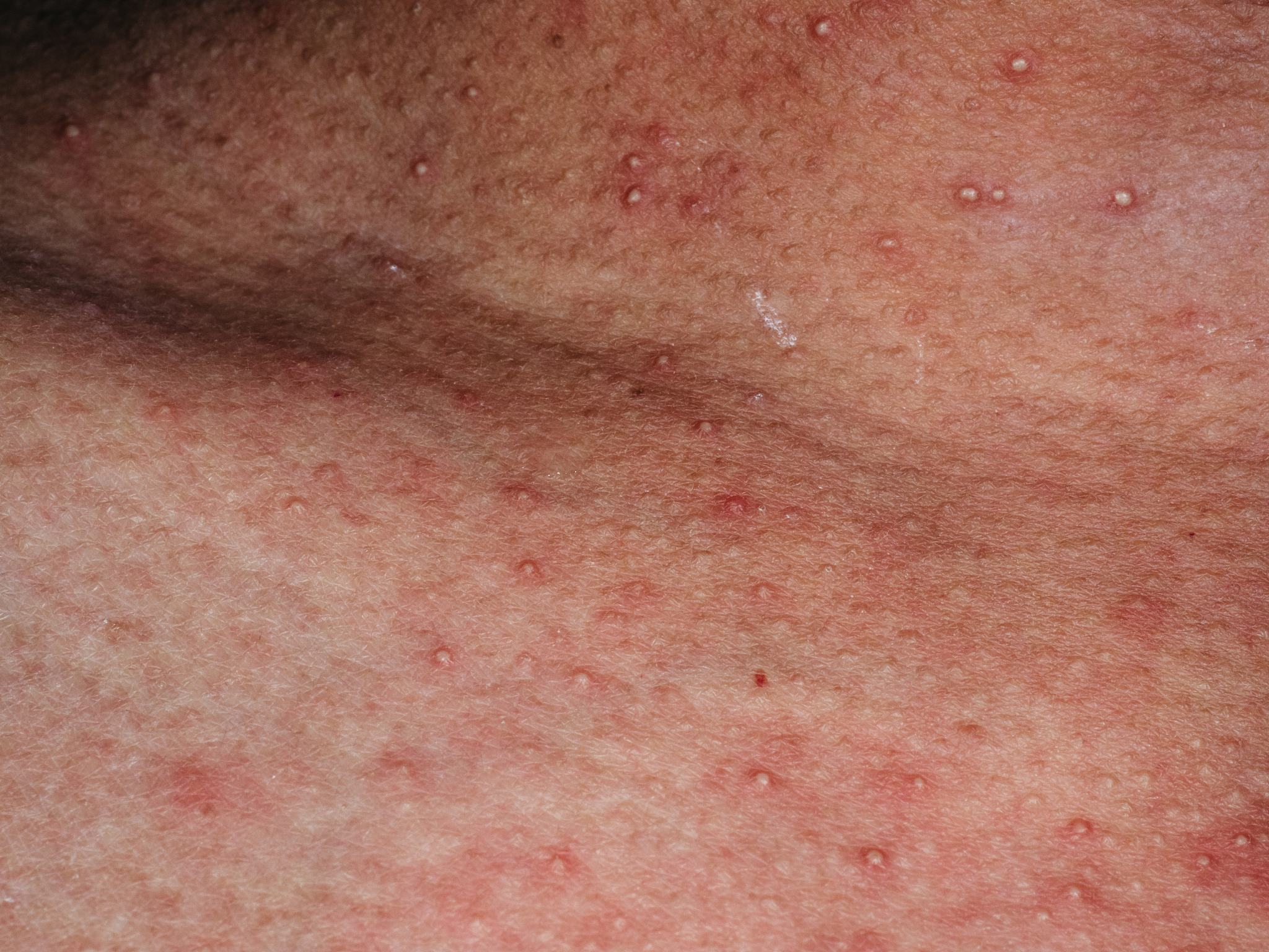 神经性皮炎和过敏性皮炎的区别？