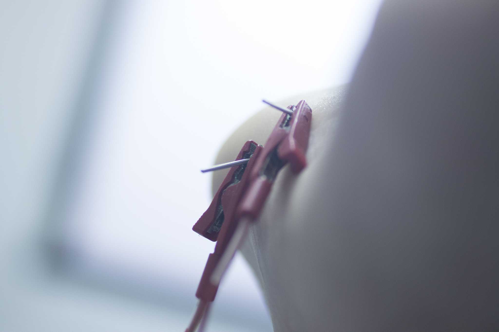 close-up of acupuncture needles in hand