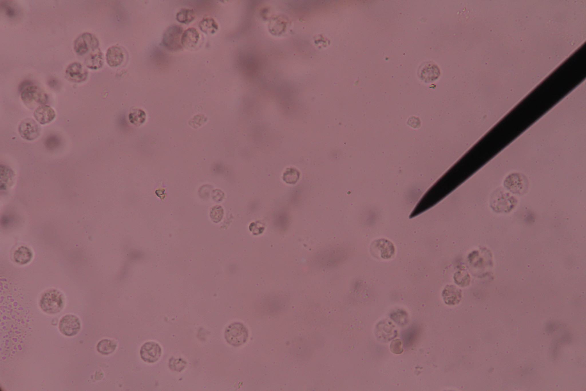45岁女性尿频尿急3天，检查结果提示需要进一步检查