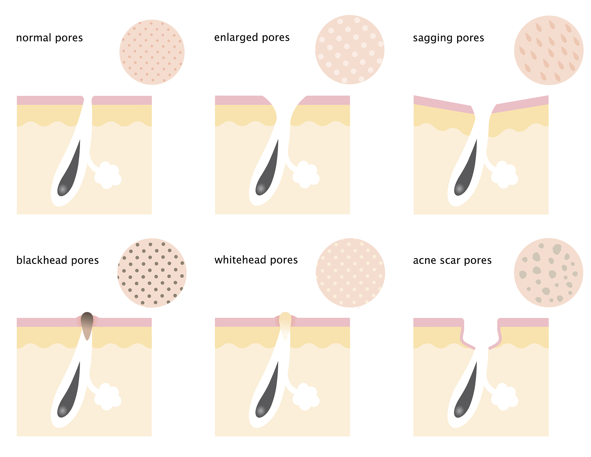 如何缩小毛孔：七个有效方法