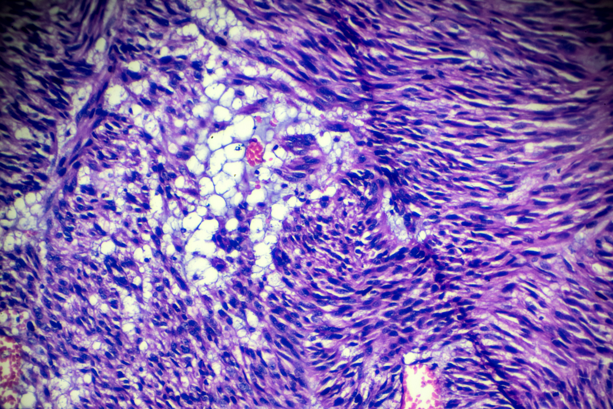 子宫肌瘤术后护理指南：预防感染、减轻疼痛、促进恢复