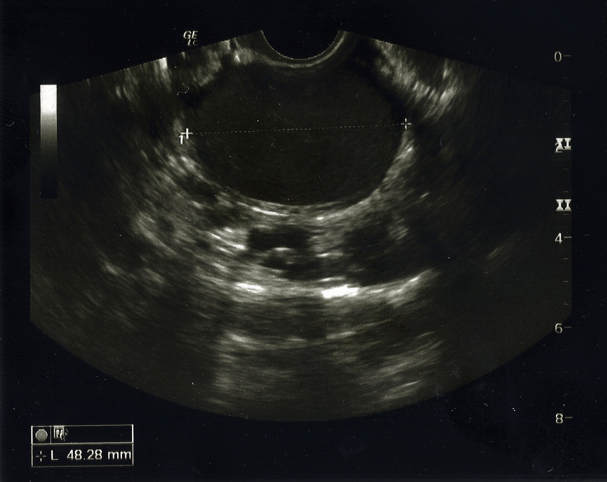 卵巢子宫内膜异位囊肿：流行病学、致病原因及最新研究
