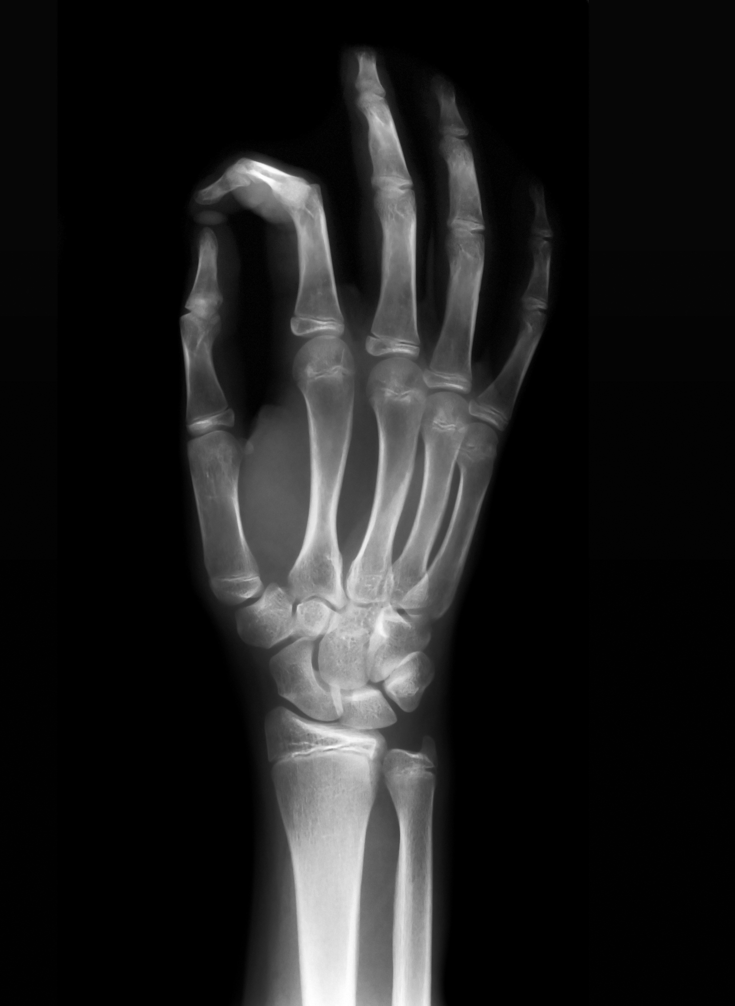 传统的骨龄预测方法