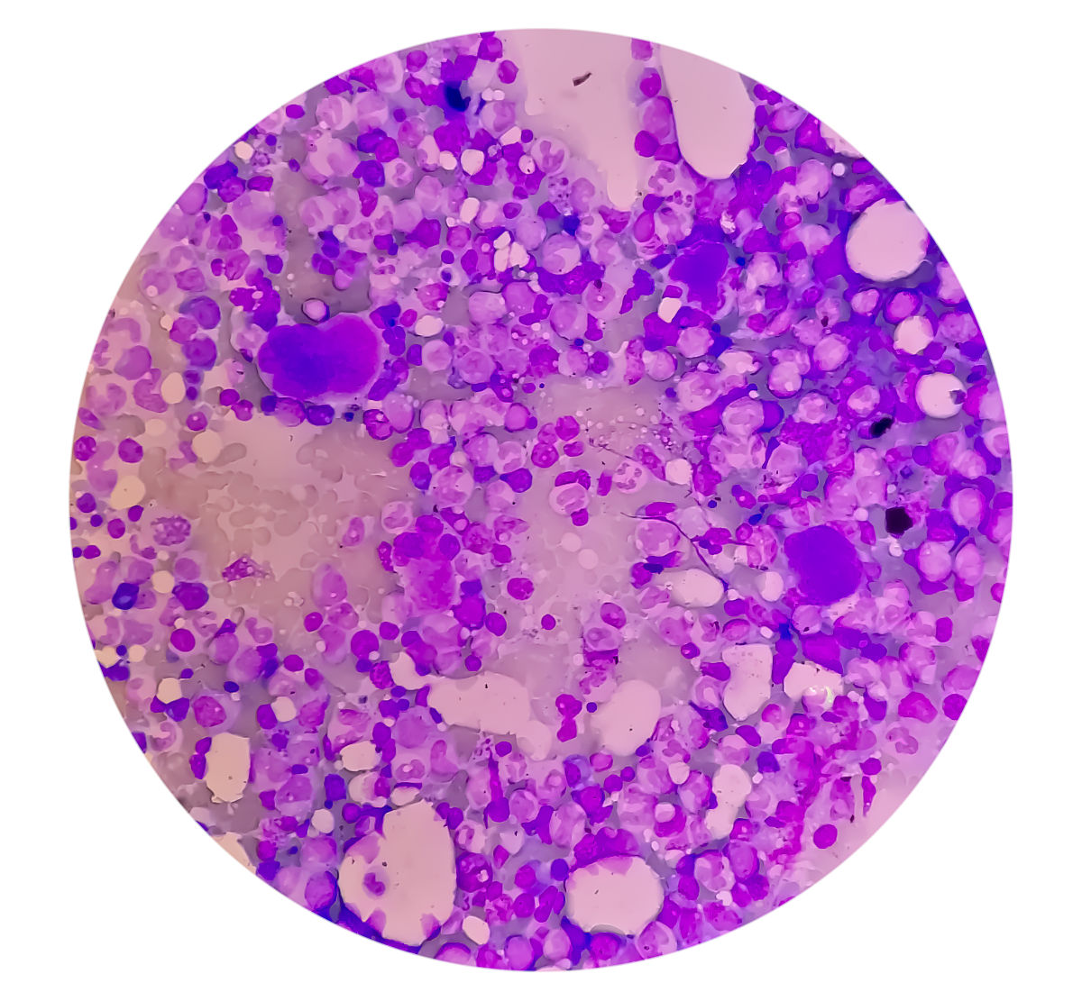 骨髓造血停滞的原因：常见病因及影响