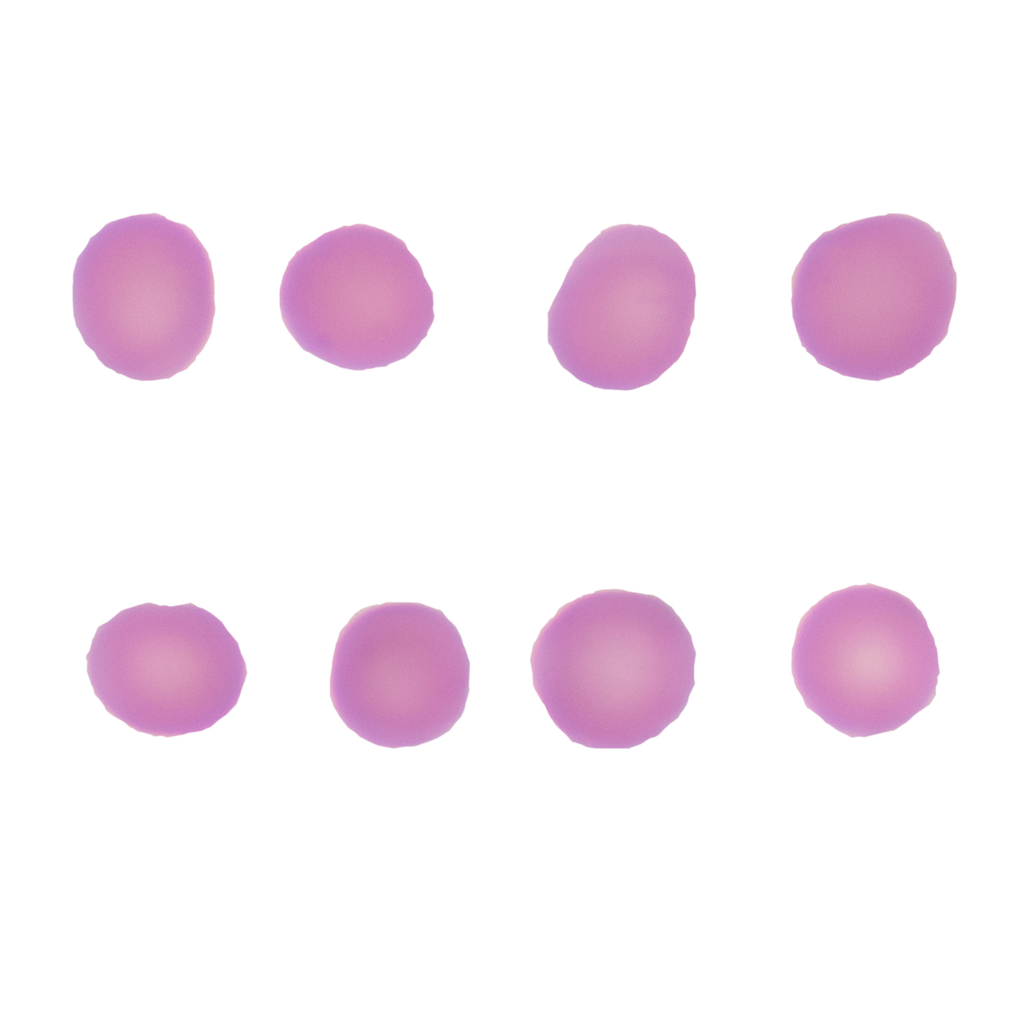 血液透析患者贫血：原因、影响及后果