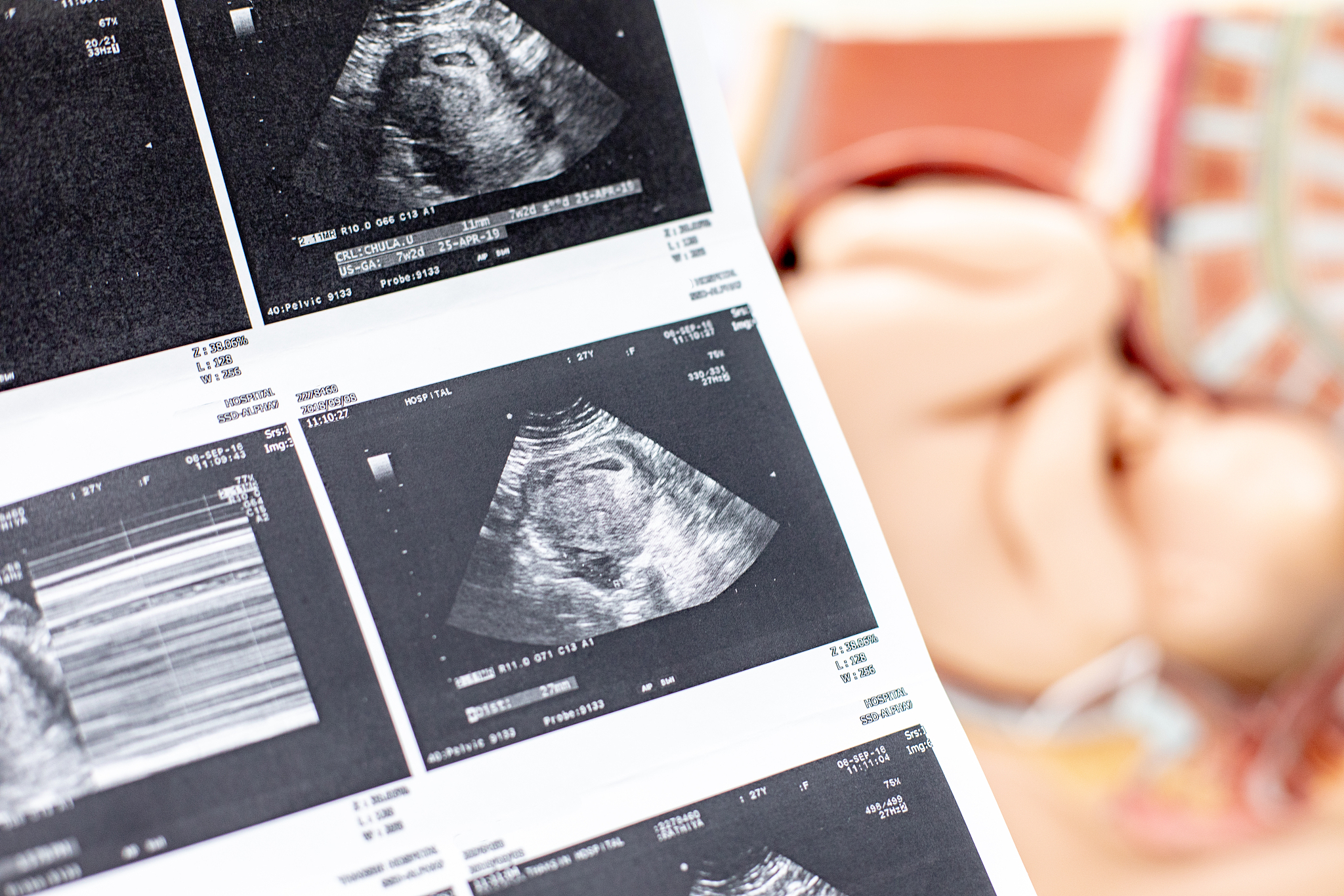 翻译：BackgroundEndometrial scratching with the use of a pipelle biopsy is a technique proposed to facilitate embryo implantation and increase the probability of pregnancy in women undergoing in vitro fe