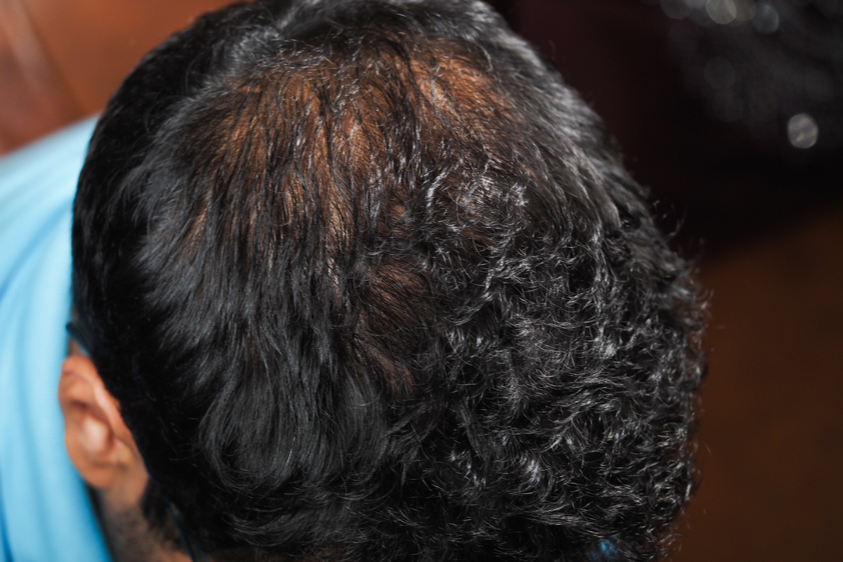 脱发与肾虚：真相与预防