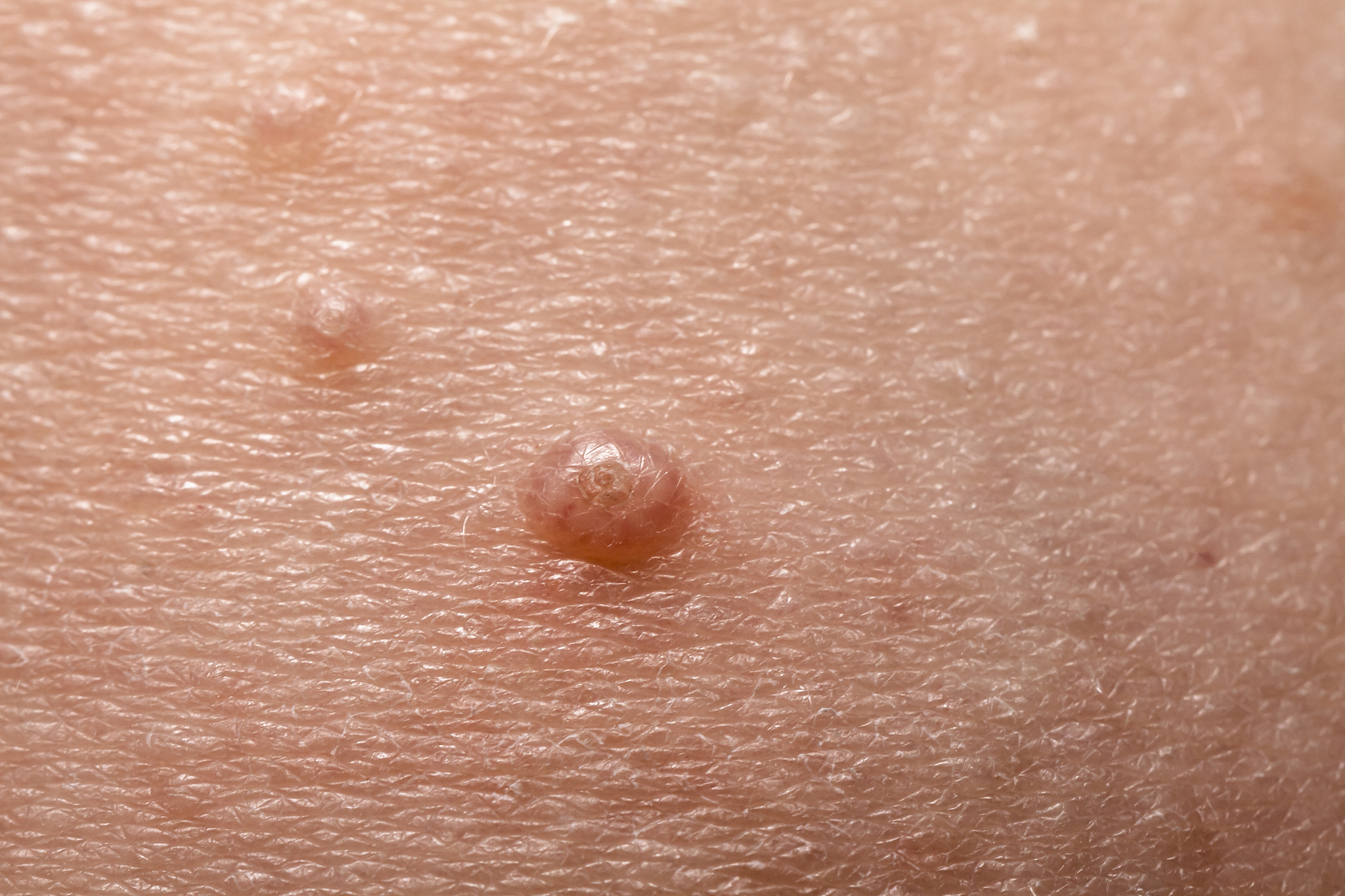 close up of molluscum contagiosum also called water wart