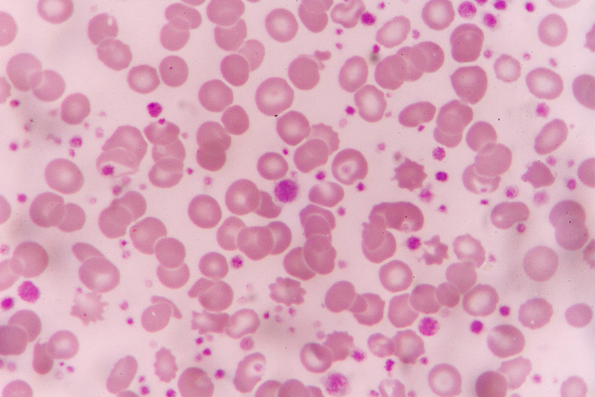 再生性贫血：症状、检查和诊断