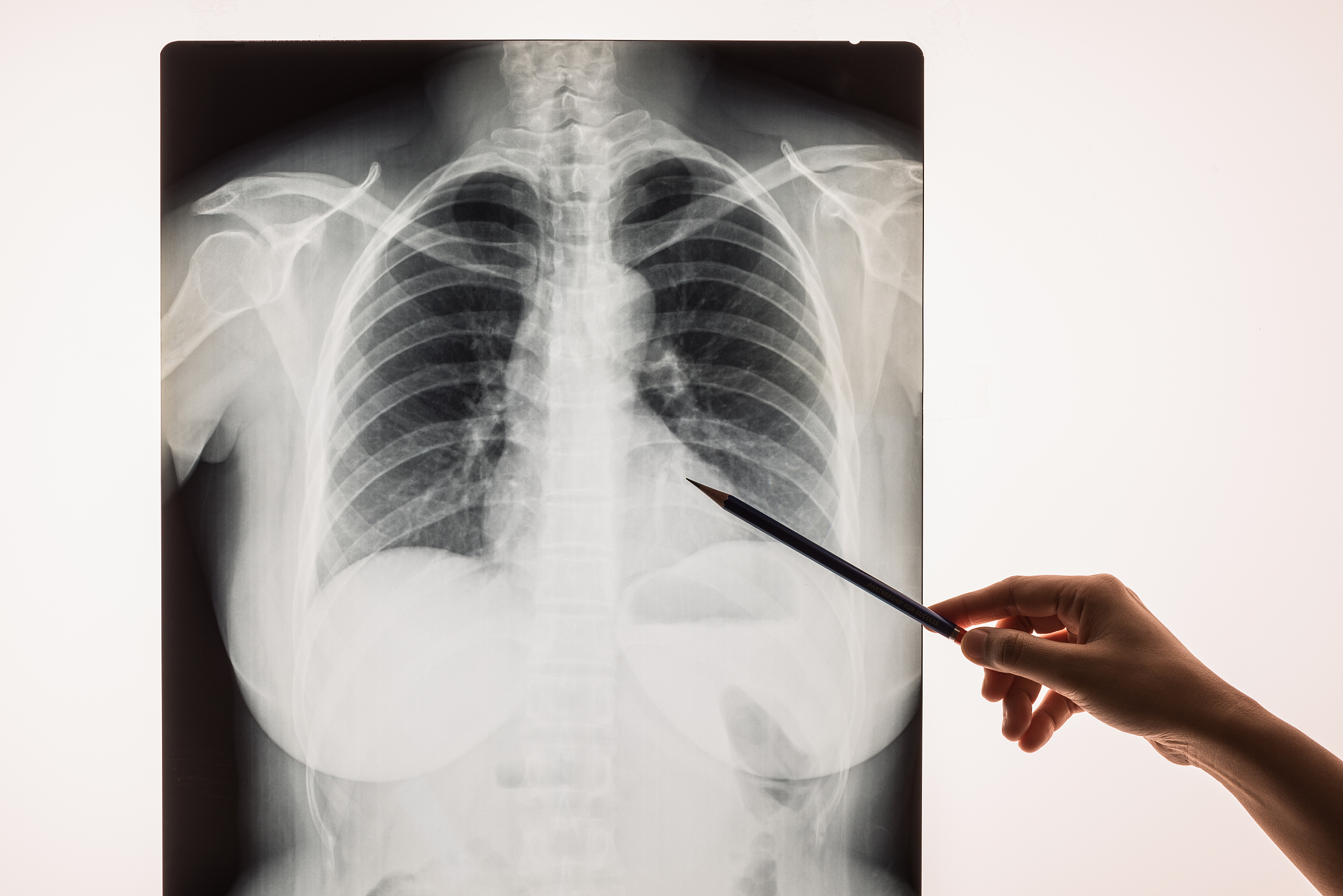 心身医学诊断支气管哮喘