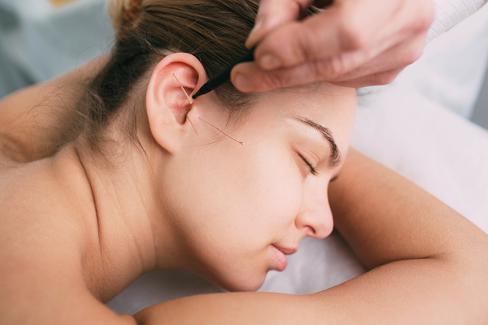 acupuncturist inserting a needle into a female face
