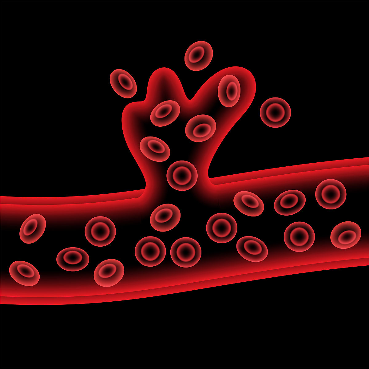 写一篇关于脑中风的文章